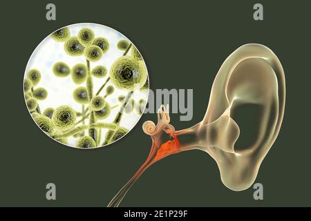 Otite fungina cronica media infezione dell'orecchio, illustrazione Foto Stock