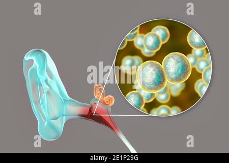 Otite media infezione dell'orecchio, illustrazione Foto Stock