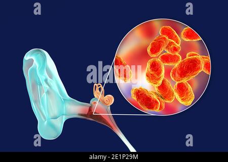 Otite media infezione dell'orecchio, illustrazione Foto Stock