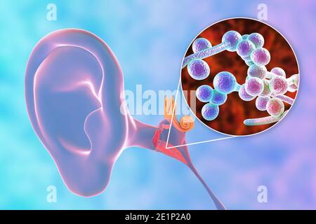 Otite fungina cronica media infezione dell'orecchio, illustrazione Foto Stock