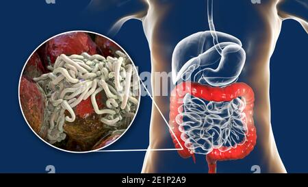 Vermi rotondi nell'intestino crasso umano, illustrazione Foto Stock