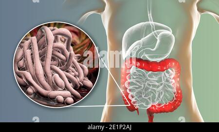 Vermi rotondi nell'intestino crasso umano, illustrazione Foto Stock