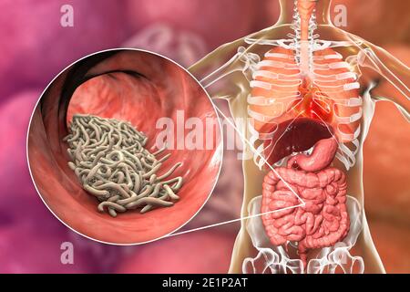 Vermi rotondi nell'intestino umano, illustrazione Foto Stock