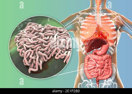 Vermi rotondi nell'intestino umano, illustrazione Foto Stock