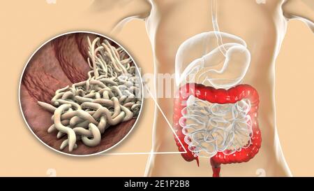 Vermi rotondi nell'intestino crasso umano, illustrazione Foto Stock