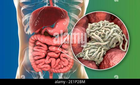 Vermi rotondi nell'intestino umano, illustrazione Foto Stock