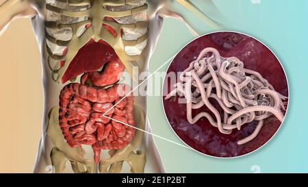 Vermi rotondi nell'intestino umano, illustrazione Foto Stock