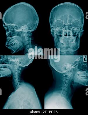 Cranio di raccolta di immagini a raggi x in tonalità blu Foto Stock