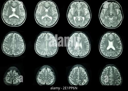 Scansione MRI del cervello di un paziente Foto Stock