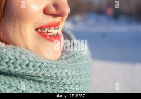 La ragazza ha dei rinforzi sui denti. Una ragazza in inverno sulla strada sorride e bretelle sono visibili sui suoi denti. Denti lisci dall'installazione di Foto Stock