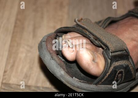 Il chiodo è rotto sulla punta. Fungo sulle unghie Foto Stock