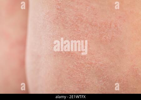 Primo piano l'eczema atopico grave sulle gambe dietro le ginocchia di un bambino è una malattia dermatologica della pelle. Eruzione cutanea grande, rossa, infiammata e scalosa sul Foto Stock