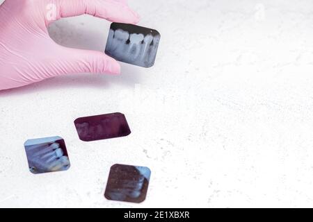 Medico che tiene e guarda le immagini radiografiche di foto dentali su la pellicola a raggi x rappresenta le radici dei denti di il gruppo di masticazione viene sigillato dopo l'endodone Foto Stock