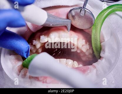 Fotografia macro. Processo di pulizia nella bocca del paziente con riavvolgitore della guancia e staffe sui denti. Pulizia dei denti con getto d'acqua ed espulsore di saliva. Concetto di igiene dentale professionale Foto Stock