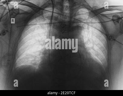 Immagine radiografica di polmoni e cuore. Foto Stock