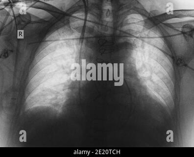 Immagine radiografica del paziente dopo intervento chirurgico cardiaco. Foto Stock