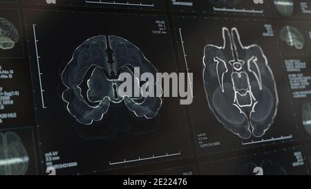 3d analisi di un cervello umano con imaging a risonanza magnetica rm tecnica foto stock alamy