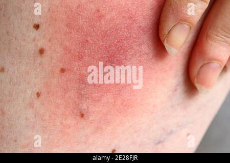 Arrossamento di una zecca di Lyme borreliosi malattia sulla gamba di una donna. Arrossamento della pelle sulla gamba dovuto ad un'allergia Foto Stock