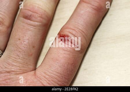 Una lesione da sanguinamento sul dito di una donna. Una ferita sanguinante sulla mano Foto Stock