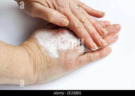 Una donna sfrega le mani con un unguento di dolore. Crema per le mani contro la pelle asciutta Foto Stock