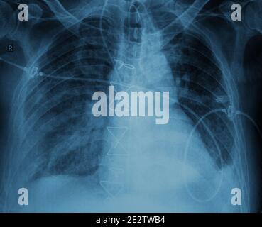 Dopo l'intervento chirurgico raggi X del paziente con sutura. Foto Stock