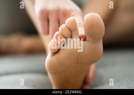 Infezione fungina del piede dell'atleta. Prurito tra le dita dei piedi Foto Stock