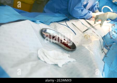 Coaguli di sangue eliminati dai vasi durante l'intervento chirurgico. Foto Stock