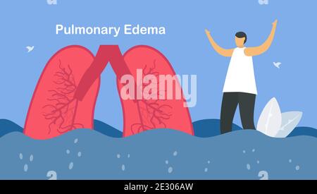 L'edema polmonare è sintomo che i polmoni si riempiono di liquido. Altri nomi sono la congestione polmonare, l'acqua polmonare e la congestione polmonare. ฺBody lotta per ottenere it Illustrazione Vettoriale