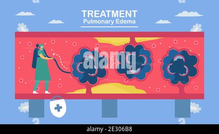 L'edema polmonare è sintomo che i polmoni si riempiono di liquido. Trattamento e diagnostica. Il corpo lotta per ottenere abbastanza ossigeno fino a mancanza di respiro. Illustrazione Vettoriale