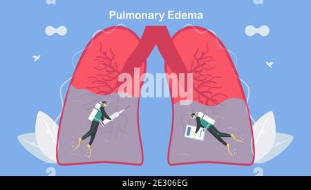 L'edema polmonare è sintomo che i polmoni si riempiono di liquido. Trattamento e diagnostica. Il corpo lotta per ottenere abbastanza ossigeno fino a mancanza di respiro. Illustrazione Vettoriale