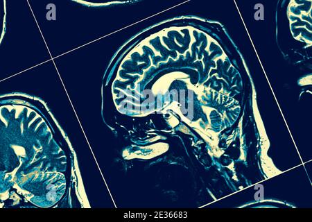 Sezione sagittale del cervello. Foto Stock