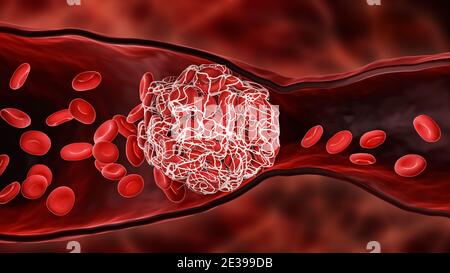 Coagulo di sangue o trombo che blocca il flusso di globuli rossi all'interno di un'arteria o di una vena illustrazione 3D. Trombosi, sistema cardiovascolare, me Foto Stock