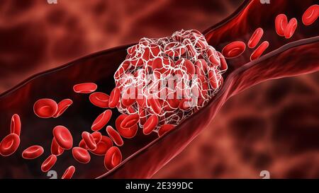 Coagulo di sangue o trombo che blocca il flusso di globuli rossi all'interno di un'arteria o di una vena illustrazione 3D. Trombosi, sistema cardiovascolare, me Foto Stock