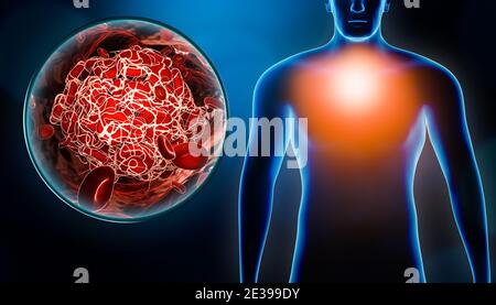 Uomo che soffre di dolore toracico dovuto a embolia o embolo con coagulo di sangue o immagine trombo 3D rappresentazione. Medicina, condizione medica, salute, Foto Stock