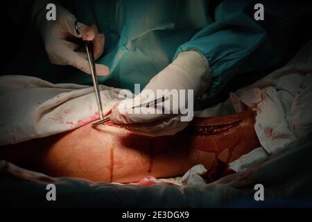 Il chirurgo fa suturing profondo su malato per arrestare il sanguinamento del paziente della gamba dopo l'intervento chirurgico Foto Stock