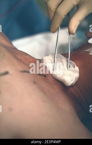 L'infermiere si occupa del trattamento di pazienti maschi con tampone di garza in soluzione disinfettante prima dell'intervento chirurgico. Foto Stock