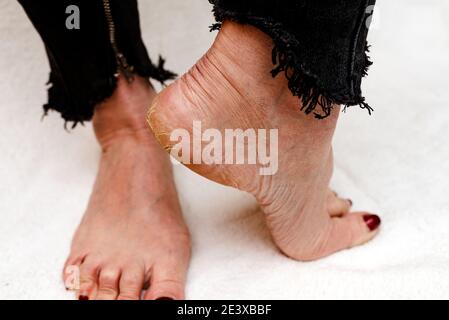 Suole di piedi asciutte e fessurate. Piedi Womans con tacchi asciutti, cracked skin.White sfondo morbido. Foto Stock