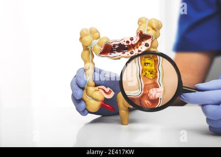 Modello del colon con le malattie differenti nelle mani dei medici. Tumore del colon ingrandito in una lente di ingrandimento Foto Stock