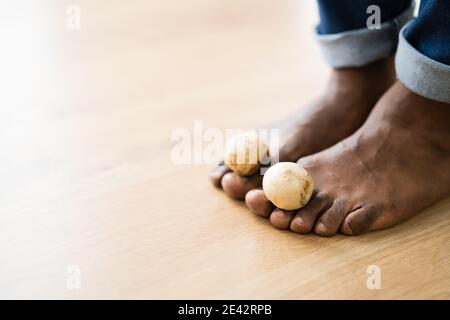 Piedi funghi fungo tra Toenail. Funghi del piede Foto Stock