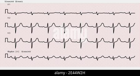 Carta per elettrocardiogramma, carta millimetrica. Illustrazione vettoriale Illustrazione Vettoriale