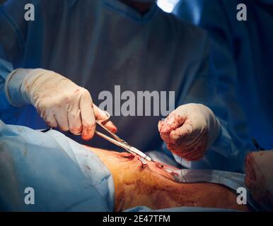 Primo piano delle mani del medico in guanti sterili taglio filo con forbici mentre si posizionano le suture dopo un intervento chirurgico di pancia tuck. Operaio medico che esegue chirurgia plastica addominale. Concetto di abdominoplastica. Foto Stock