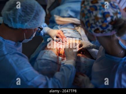 Primo piano di chirurgo maschile e assistente femminile che cuciscono la ferita dopo l'intervento di Tummy Tuck. Focus su medici mani che conducono chirurgia plastica addominale in sala operatoria. Concetto di abdominoplastica. Foto Stock