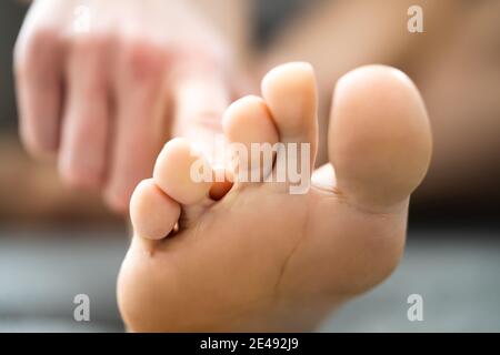 Il piede d'Atleta infezione in piedi del paziente Foto stock - Alamy