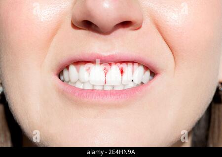 Bocca della donna con gengive sanguinanti. Malattia parodontale Foto Stock