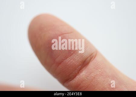 Sul dito c'è il callo rosso e un ascesso Foto Stock