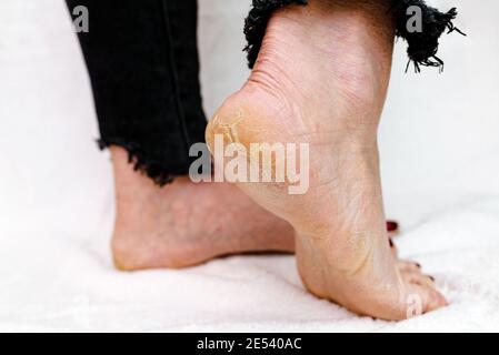 Suole di piedi asciutte e fessurate. Piedi Womans con tacchi asciutti, cracked skin.White sfondo morbido. Foto Stock