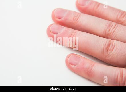 Primo piano vista della malattia della pelle chiamata verruca causata dal virus del papilloma umano sul dito umano. Foto Stock