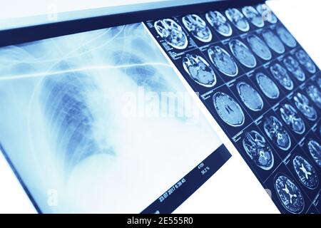 Risultati dell'indagine sul negatoscopio nell'ufficio del medico. Foto Stock