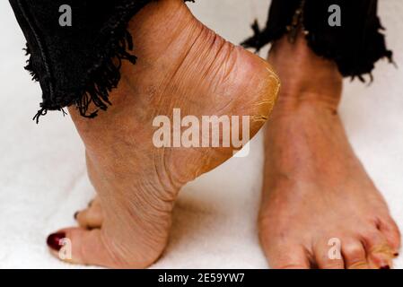 Suole di piedi asciutte e fessurate. Piedi Womans con tacchi asciutti, cracked skin.White sfondo morbido. Foto Stock