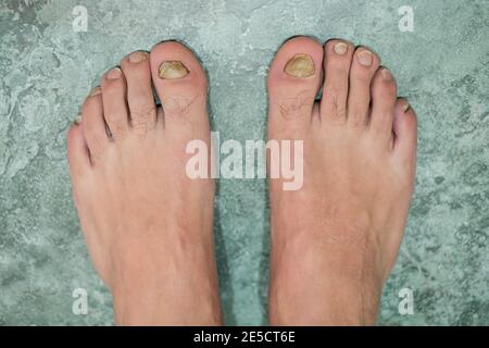Giovane uomo a piedi nudi dita con onycho malato micosi unghie, dermatologico medico malattia,problema di salute Foto Stock